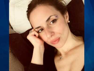 Ana Walsh with eye injury