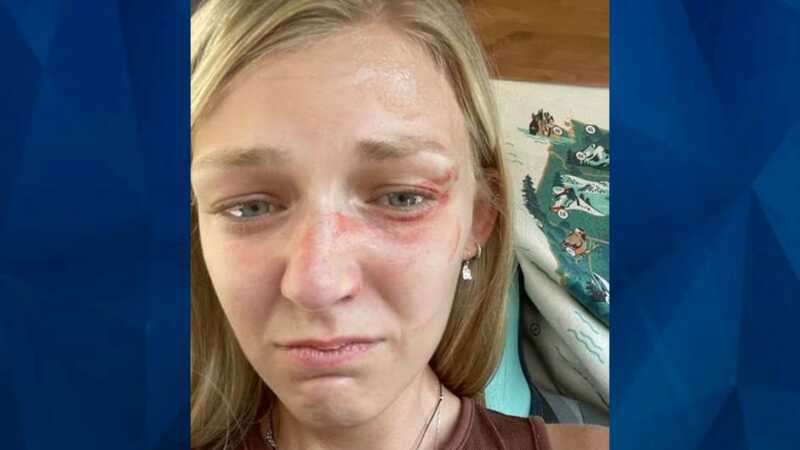 Gabby Petito bruised face